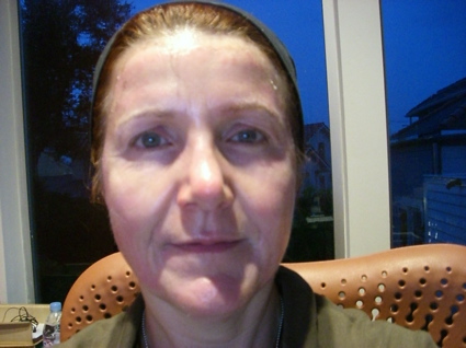 chemicalpeel7.jpg